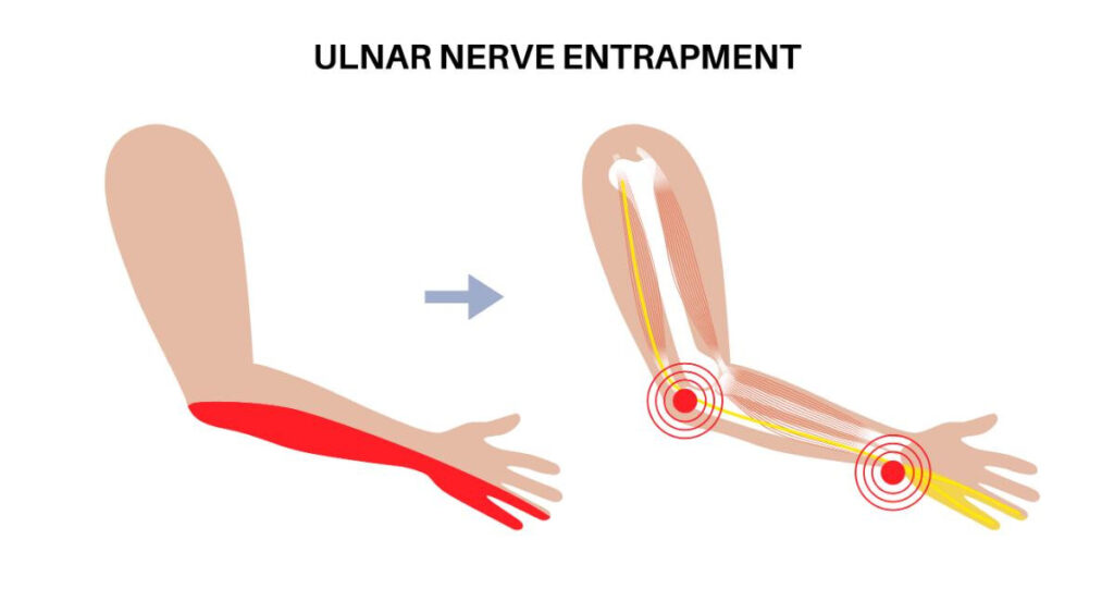 Ulnar Sinir Sıkışması